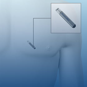 icm insertable cardiac monitoring